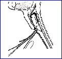 Eliachar Laryngeal Stent2