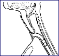 Eliachar Laryngeal Stent3