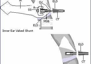 Inner Ear Shunt